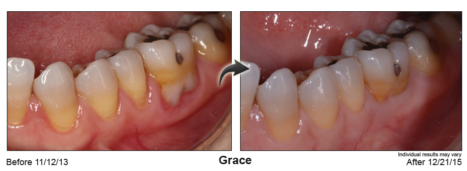 fix gum recession Deerfield Beach, Florida