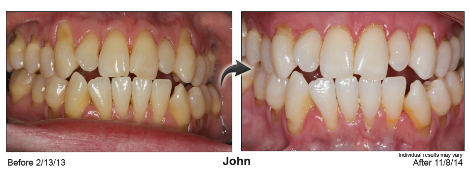 Deerfield Beach, Florida gum recession