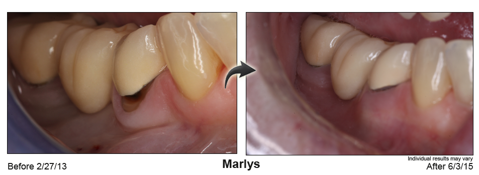 fix receding gums Deerfield Beach, Florida