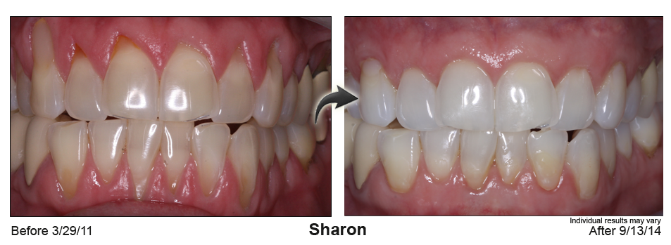 gum recession treatment Deerfield Beach, Florida